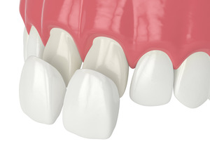 Veneers being placed on the front teeth after enamel has been removed